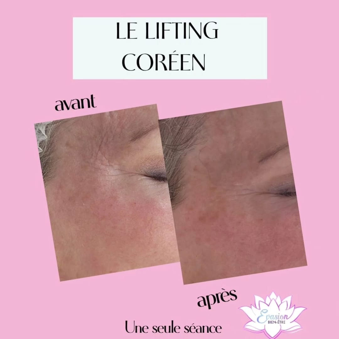 Lifting coréen : le contour de l'œil avant et après une séance
